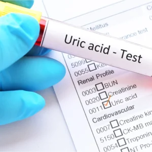 Serum Uric Acid Test