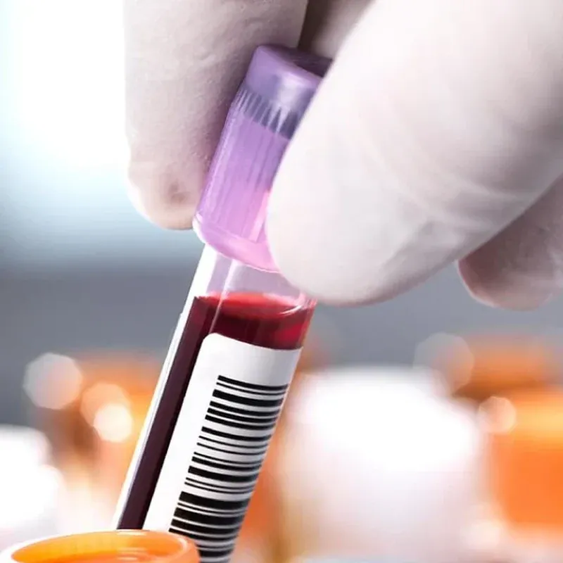 Carbamazepine Test (Tegretol)